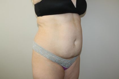 Tummy Tuck Before & After Patient #3020
