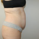 Tummy Tuck Before & After Patient #3020