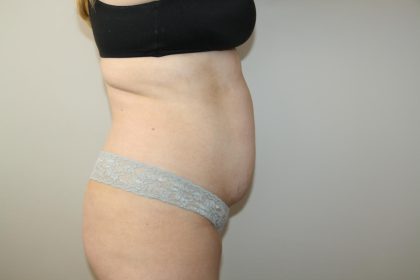 Tummy Tuck Before & After Patient #3020