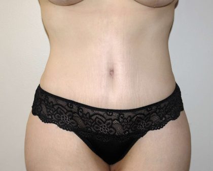 Tummy Tuck Before & After Patient #2991