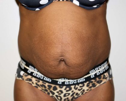 Tummy Tuck Before & After Patient #2871