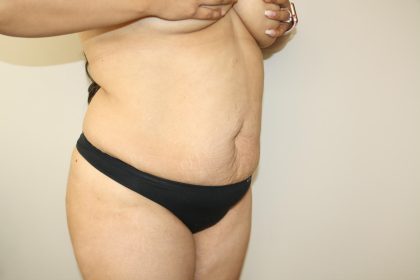 Tummy Tuck Before & After Patient #2998