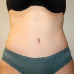 Tummy Tuck Before & After Patient #2913