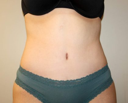 Tummy Tuck Before & After Patient #2913