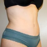 Tummy Tuck Before & After Patient #2913