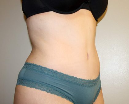 Tummy Tuck Before & After Patient #2913