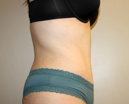 Tummy Tuck Before & After Patient #2913