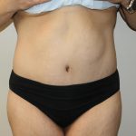 Tummy Tuck Before & After Patient #2949