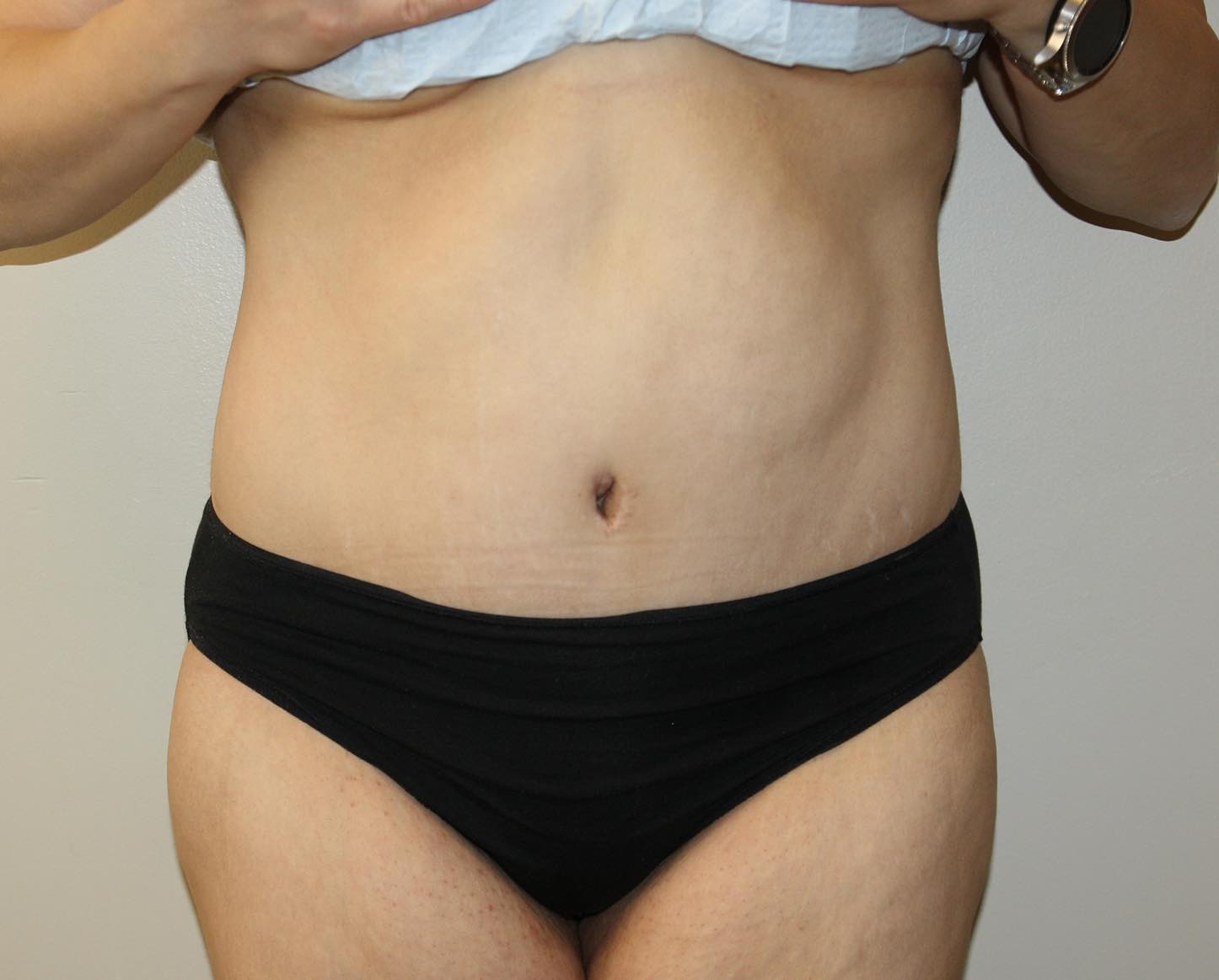 Major Weight Loss Tummy Tuck Before & After Patient #2949