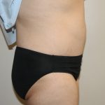 Tummy Tuck Before & After Patient #2949