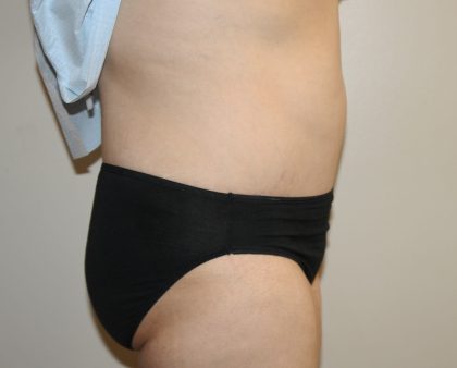 Tummy Tuck Before & After Patient #2949
