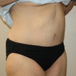 Tummy Tuck Before & After Patient #2949