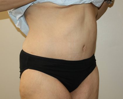 Tummy Tuck Before & After Patient #2949