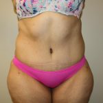 Tummy Tuck Before & After Patient #3007