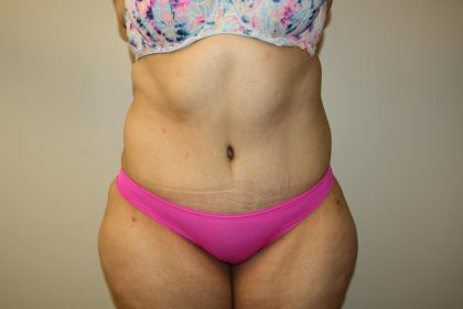 Tummy Tuck Before & After Patient #3007