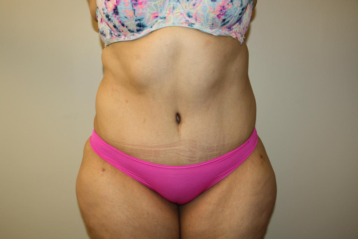 Major Weight Loss Tummy Tuck Before & After Patient #3007