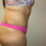 Tummy Tuck Before & After Patient #3007