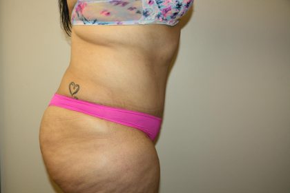 Tummy Tuck Before & After Patient #3007