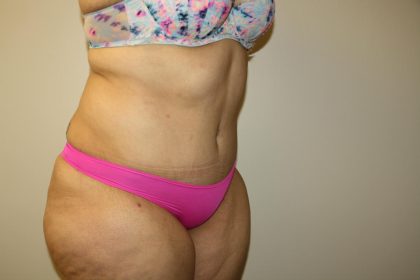 Tummy Tuck Before & After Patient #3007