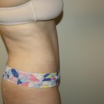 Tummy Tuck Before & After Patient #3020