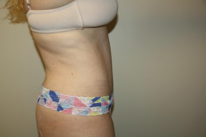 Tummy Tuck Before & After Patient #3020