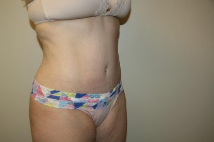 Tummy Tuck Before & After Patient #3020