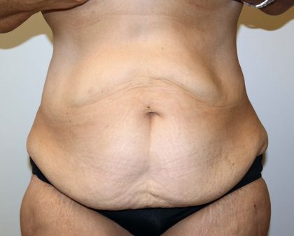 Tummy Tuck Before & After Patient #2878