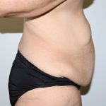 Tummy Tuck Before & After Patient #2878