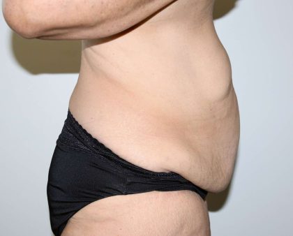 Tummy Tuck Before & After Patient #2878