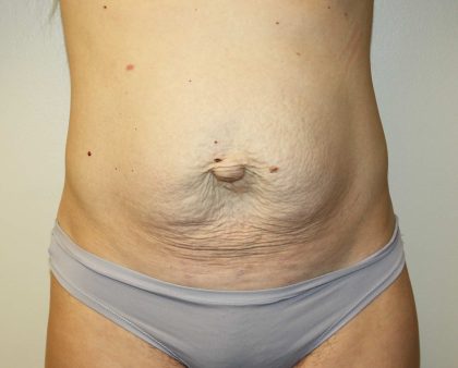 Tummy Tuck Before & After Patient #2892