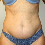 Tummy Tuck Before & After Patient #2899