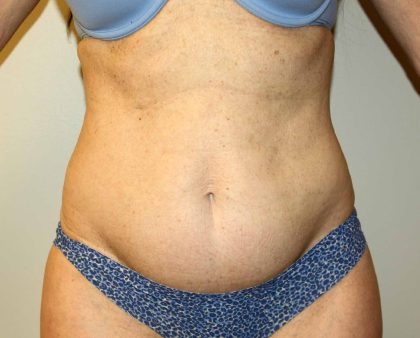 Tummy Tuck Before & After Patient #2899