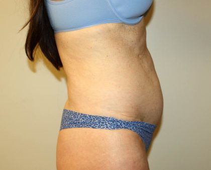 Tummy Tuck Before & After Patient #2899