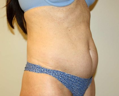 Tummy Tuck Before & After Patient #2899