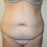 Tummy Tuck Before & After Patient #2906