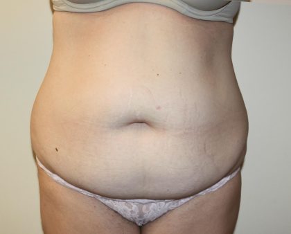 6 WAYS TO TREAT A TUMMY TUCK SCAR - Plastic Surgeon Beverly Hills,  California