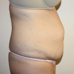 Tummy Tuck Before & After Patient #2906