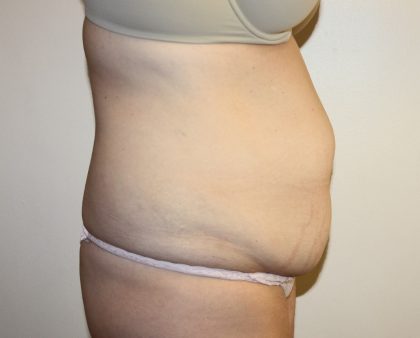 Tummy Tuck Before & After Patient #2906