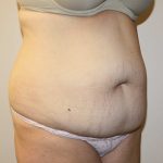 Tummy Tuck Before & After Patient #2906