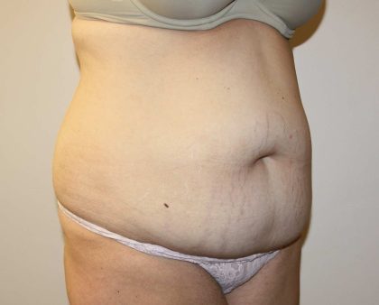 Tummy Tuck Before & After Patient #2906