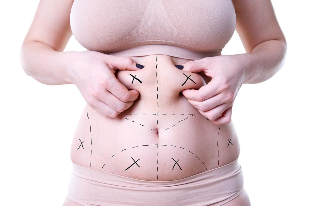 Woman's mid-section marked up for fat transfer locations.   Dr. Zarrabi.