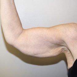 Arm Lift Before & After Patient #3108