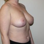 Breast Reduction Before & After Patient #3405