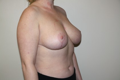 Breast Reduction Before & After Patient #3405