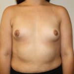 Breast Augmentation Before & After Patient #3374