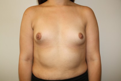 Breast Augmentation Before & After Patient #3374