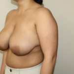 Breast Reduction Before & After Patient #3404