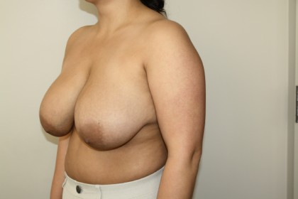 Breast Reduction Before & After Patient #3404