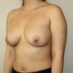 Fat Transfer to Breast Before & After Patient #3436