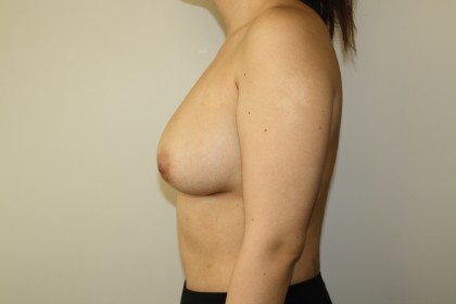 Fat Transfer to Breast Before & After Patient #3436